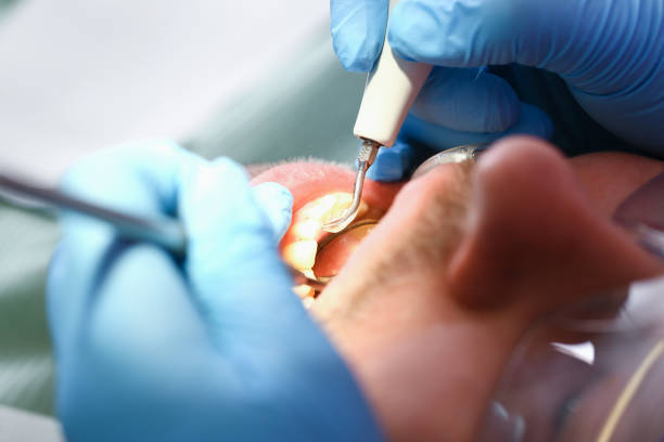 Best Walk-In Emergency Dentist in Ames Lake, WA